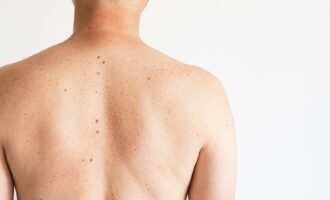 odstránenie podkožného útvaru