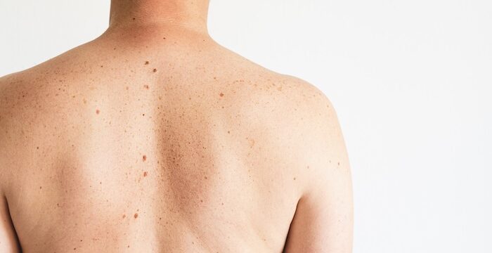 odstránenie podkožného útvaru