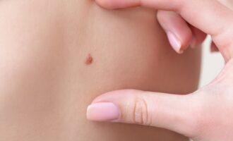 odstránenie znamienka