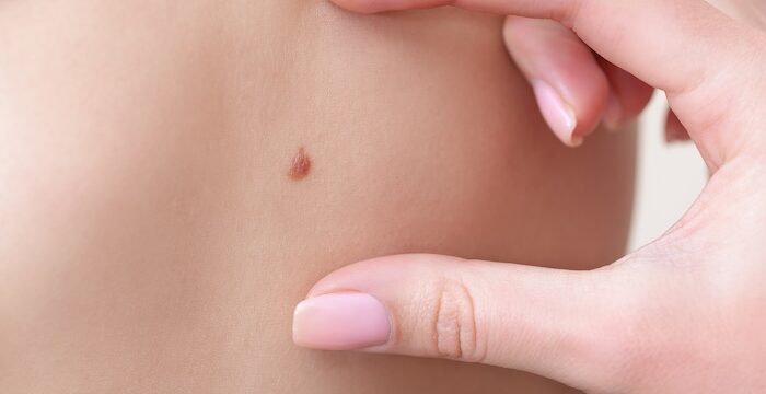 odstránenie znamienka