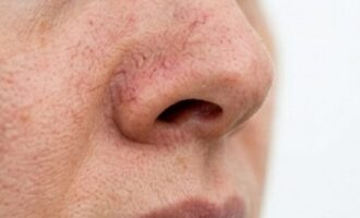odstránenie červených cievok na nose