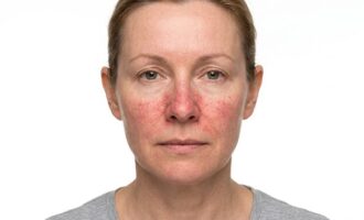 cievky na nose a priľahlých lícach