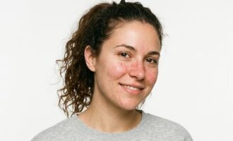 cievky na nose a celej tvári