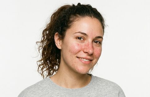 cievky na nose a celej tvári