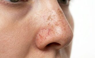 jemné žilky a pigmentové škvrny na nose