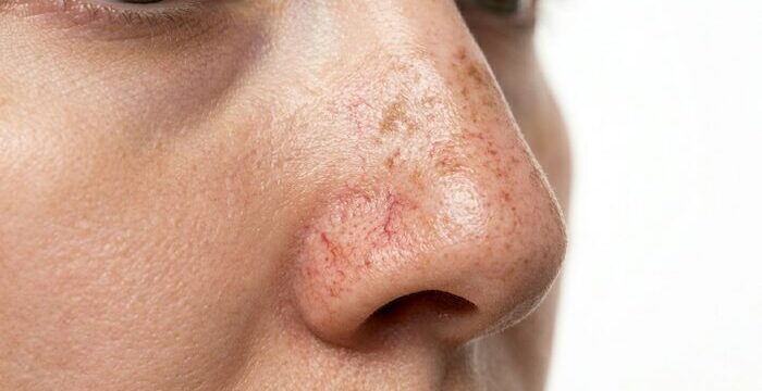 jemné žilky a pigmentové škvrny na nose