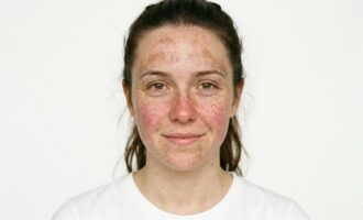 odstránenie pigmentu cievok na celej tvári